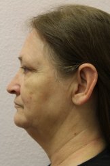 Vampire Facial 2 - Before Treatment